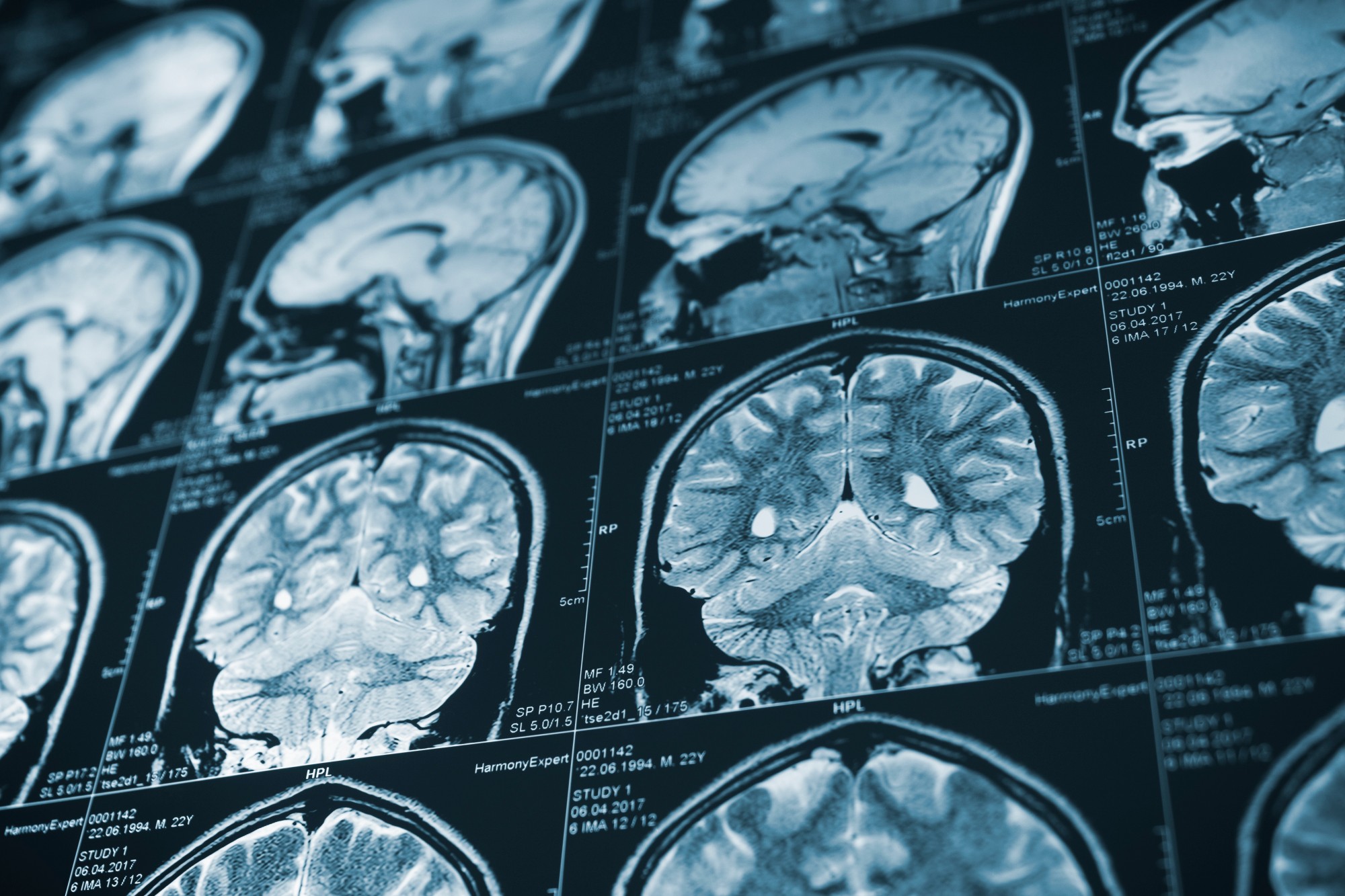 The Long-Term Costs of Traumatic Brain Injury - Santoro & Gray
